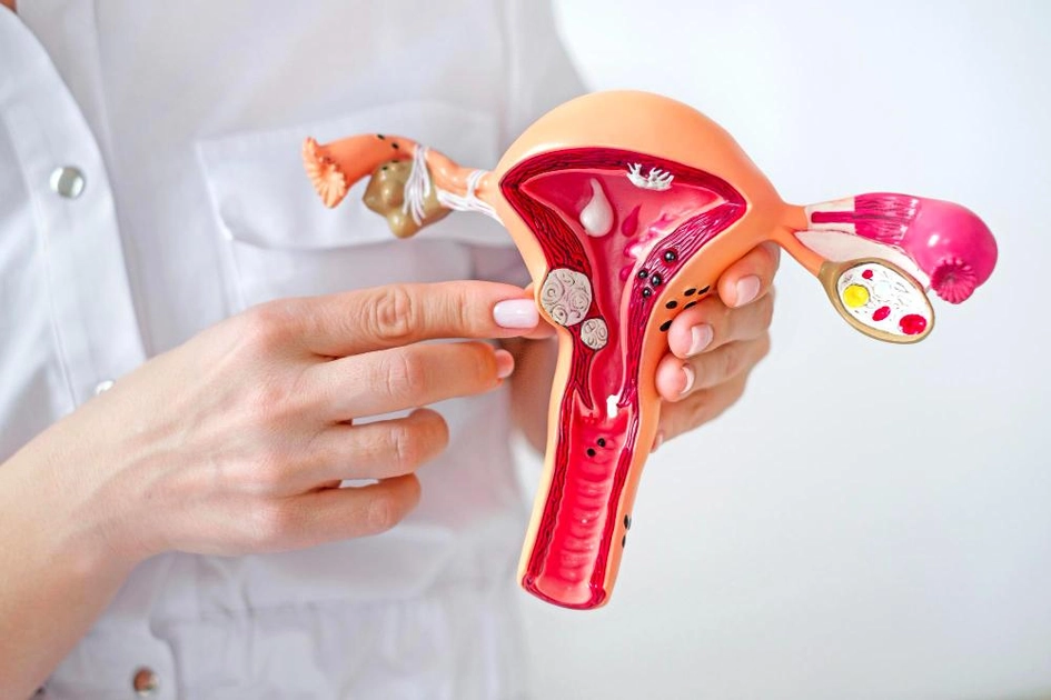 Эндометриоз: симптомы, причины и когда нужно обращаться к врачу